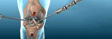 Arthroscopy and Ligament